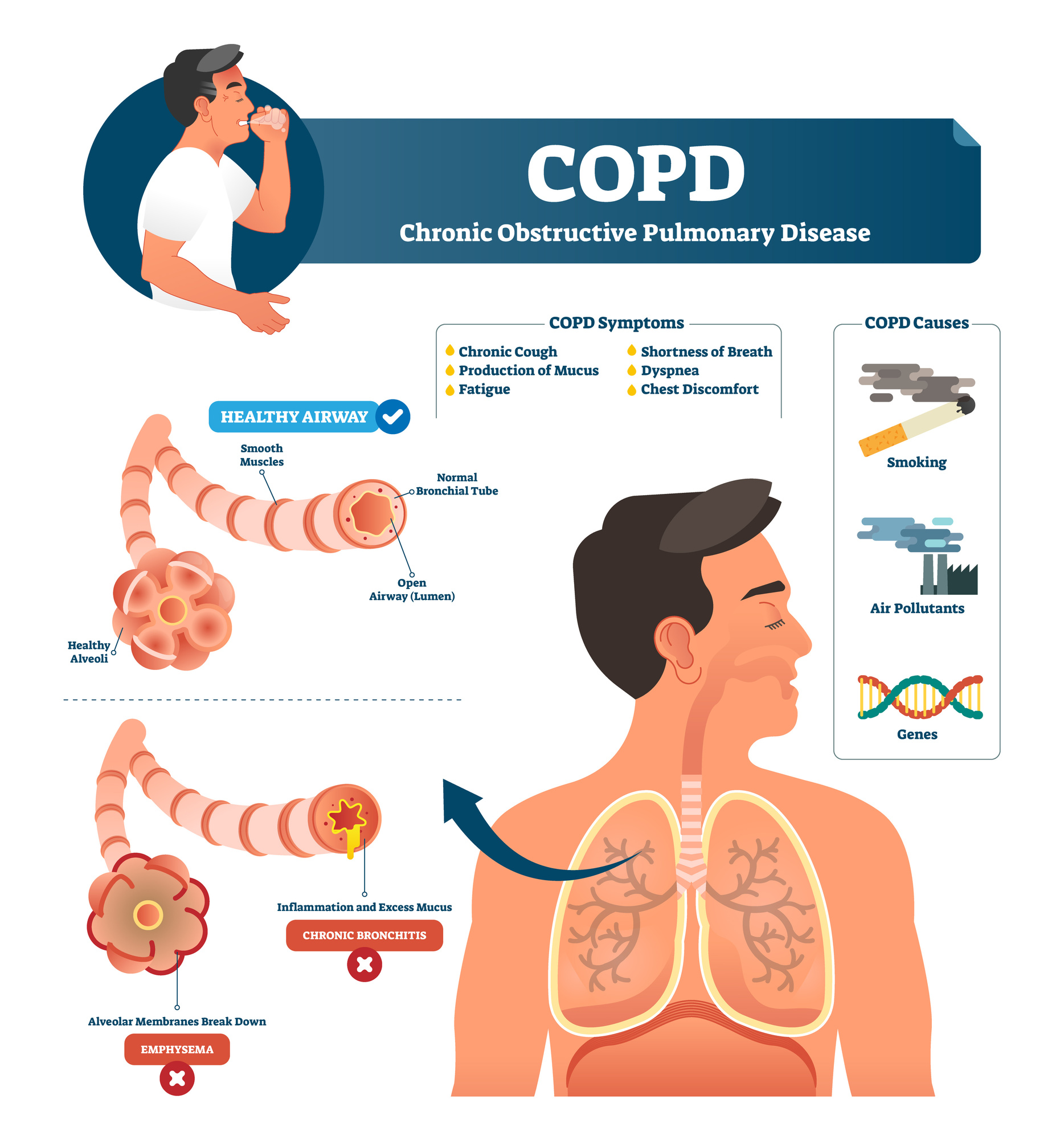 COPD vector illustration. Labeled chronic obstructive pulmonary disease explanation. Lungs inflammation symptoms and causes diagram. Compared healthy airways and emphysema or bronchitis type sickness.